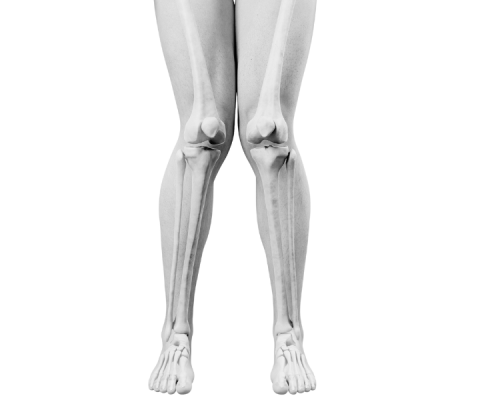 Knock Knees | Knock Knees Treatment Melbourne | Causes