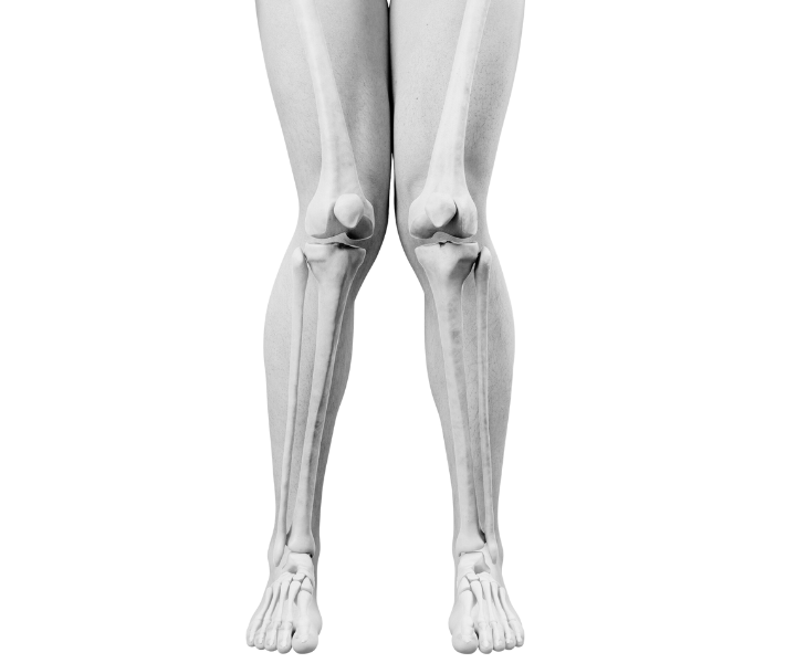 Knock Knees treatment melbourne