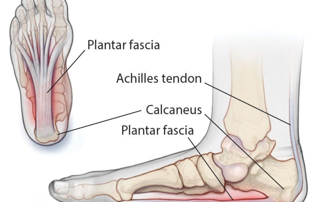 plantar fasciitis podiatrist