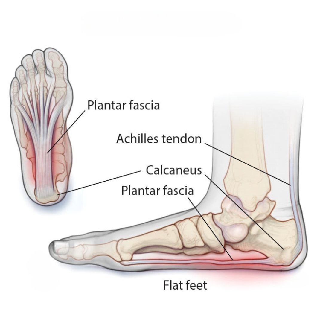 plantar fasciitis podiatrist